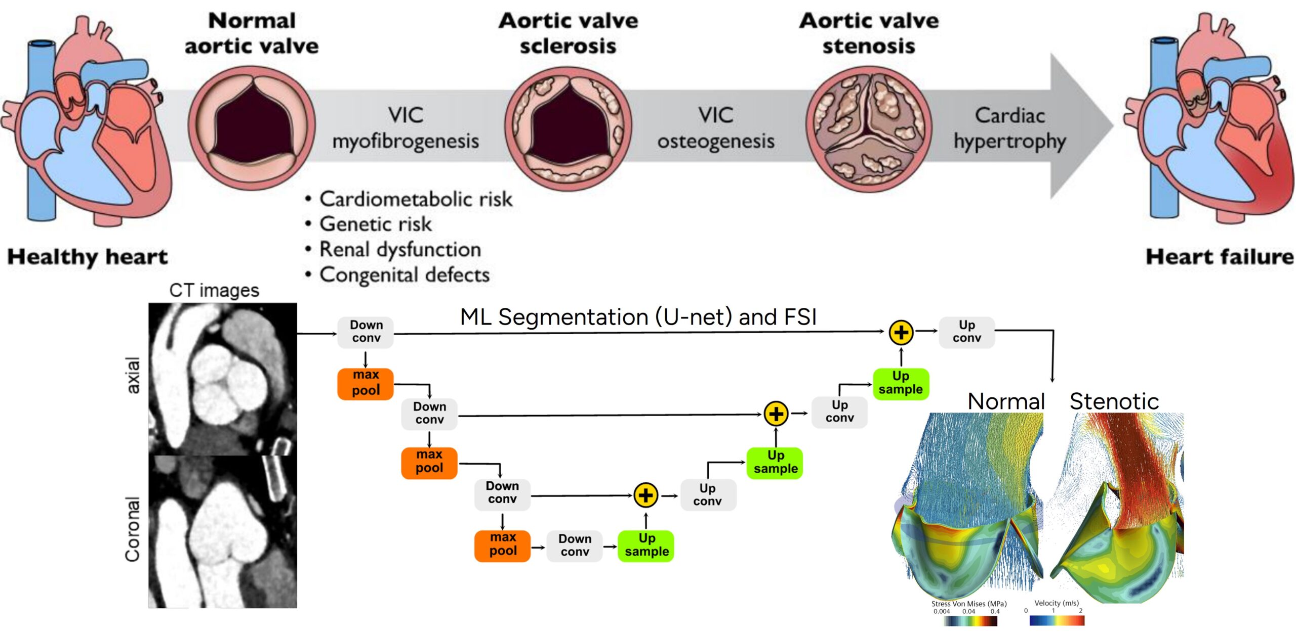 Diagram showing aortic valve disease progression, CT images, a U-net deep learning model for segmentation, and 3D colour maps comparing normal and stenotic aortic valves based on blood flow patterns.